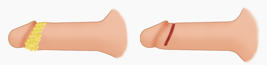 단순제거 봉합수술
