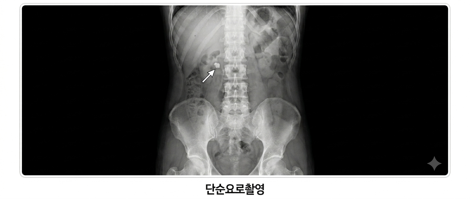 단순요로촬영 KUB