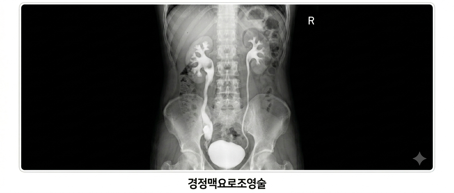 경정맥요로조영술 IVP
