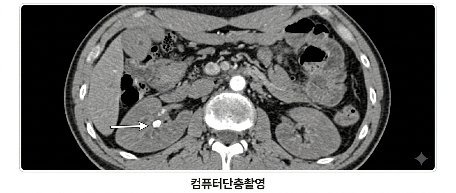 컴퓨터단층촬영 CT