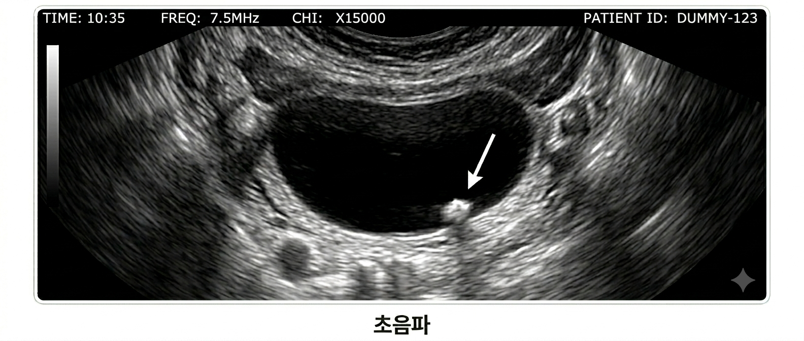 초음파 검사